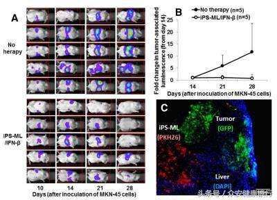 干扰素治疗肝癌的最佳时间,免疫细胞对肝癌的治疗效果