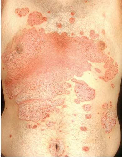 银屑病关节炎和银屑病区别,银屑病关节炎跟银屑病一样吗