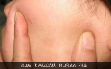 不是白癜风的白斑能查出是什么吗,不是白癜风的白点是啥