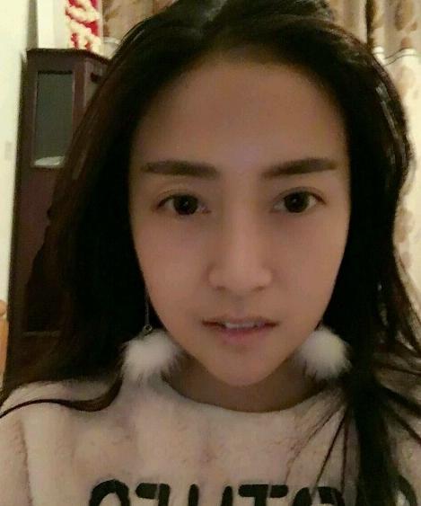 下巴后缩垫下巴案例,垫了下巴膨体皮肤松弛严重