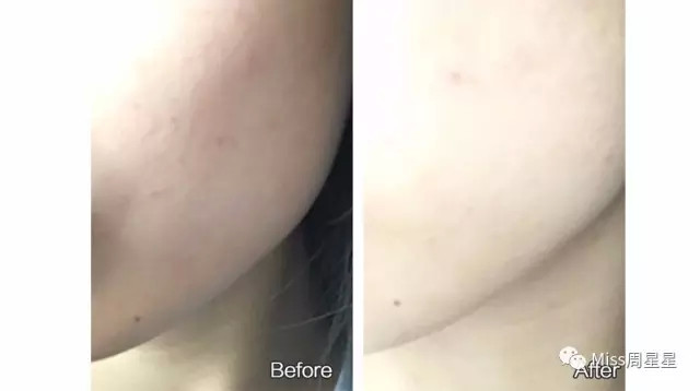 这个高科技，真的能还你十年胶原蛋白？