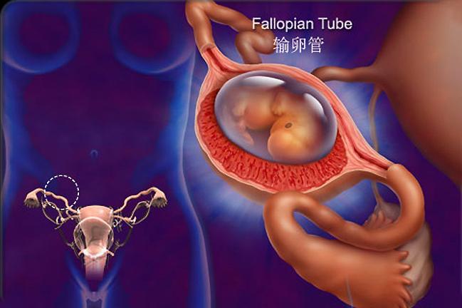 宫外孕大出血是怎么回事,宫外孕大出血前会有征兆吗