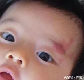 宝妈手部血管瘤,宝宝血管瘤一般多大会消退宝妈们