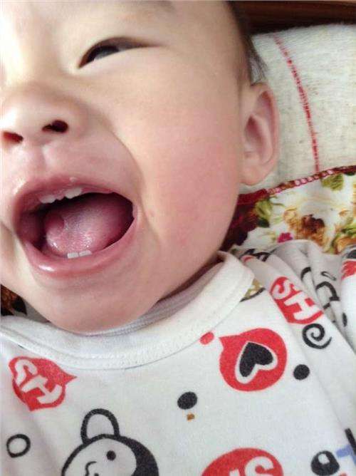 地图舌小儿照片,地图舌儿童吃什么药