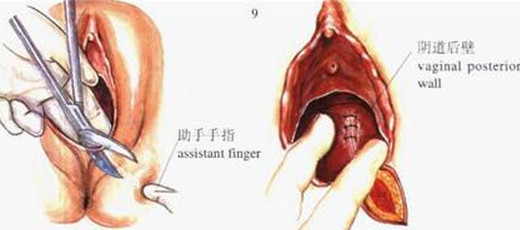 为什么女人顺产都被嫌弃,为什么孕妇老是害怕顺产