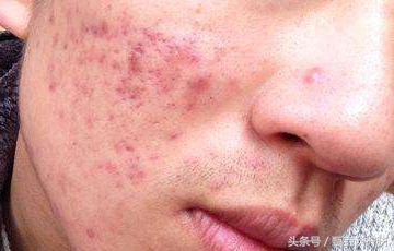 如何去除痘印,如何去除痘印留下的痣