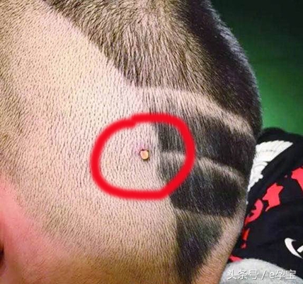 2岁女童反复高烧查不出原因,2岁娃高烧不退