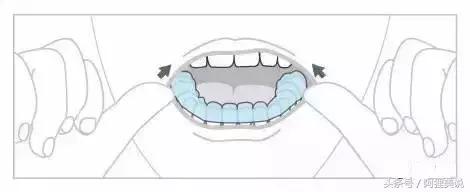 隐适美矫正摘戴攻略,隐适美和正雅隐形矫正哪个好