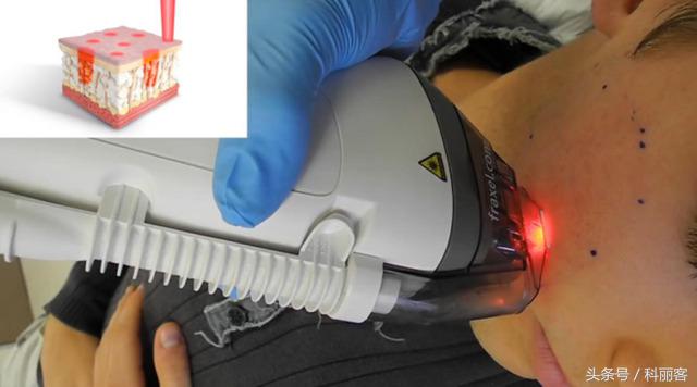 改善毛孔粗大最简单有效的方法,如何有效改善毛孔粗大的方法