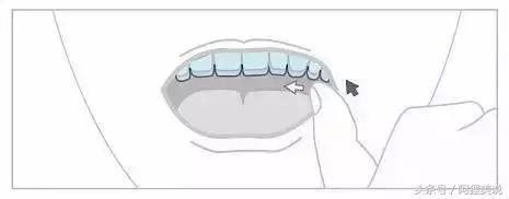 隐适美隐形矫正摘戴、保养注意事项全攻略