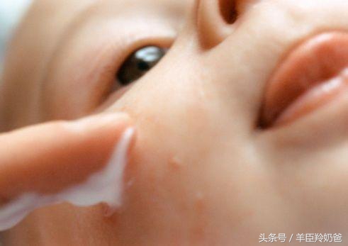 宝宝湿疹反复发作怎么办,为什么会导致宝宝湿疹反反复复