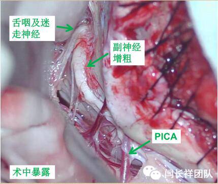 舌头突然不利索,舌头突然间不好使一会就好了