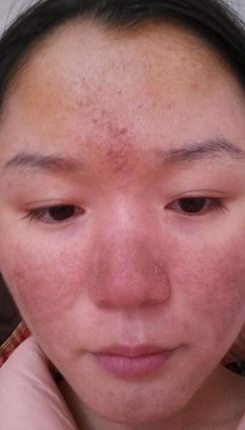 艾灸过敏发红发痒涂烫伤膏管用吗,艾灸肚脐每次都皮肤过敏怎么办