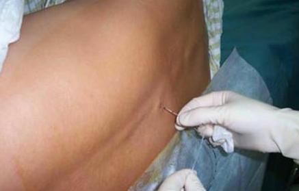 剖腹产以后过麻药的时候真难受,第二次剖腹产麻药没有效果说说