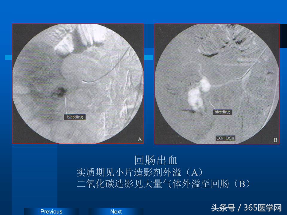 崔进国：消化道出血的介入治疗