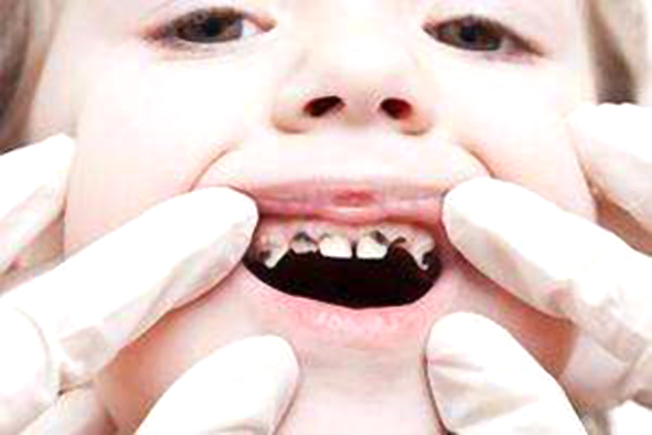 孩子烂牙严重后果视频,烂牙对心脏有什么危害