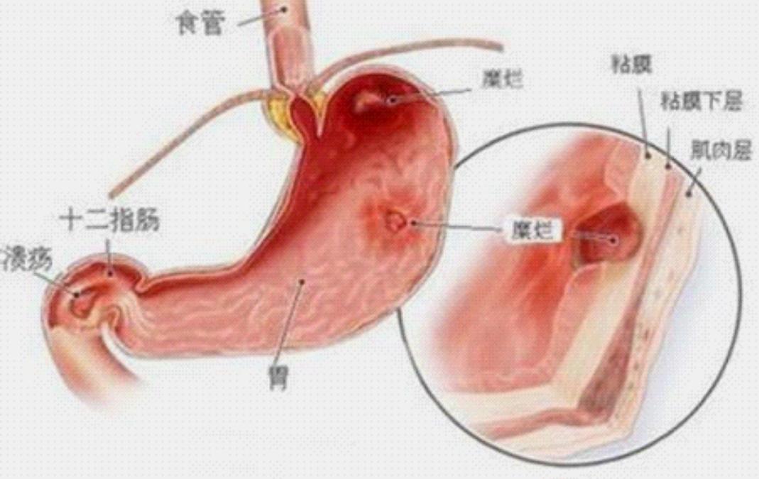 慢性胃炎胃溃疡用哪些中药调理,慢性胃炎胃溃疡的食疗方法