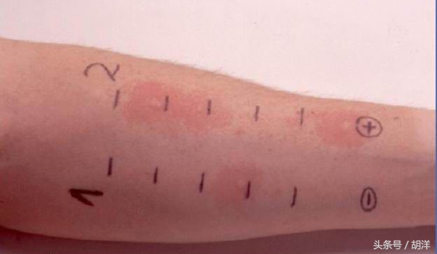 哮喘过敏源是怎么检查的,过敏性支气管哮喘怎么确定过敏源