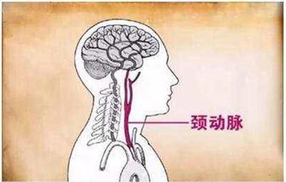 颈动脉缺血引起脑供血不足怎么办,颈动脉斑块会引起脑中风吗