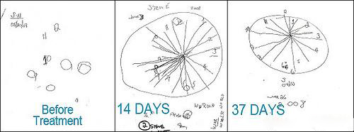 椰子油治帕金森,椰子油可以治疗帕金森综合征