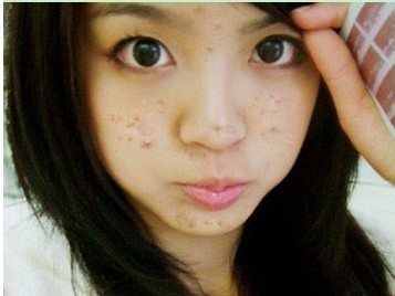 长了痘痘怎么办,肩膀上长痘痘该怎么办