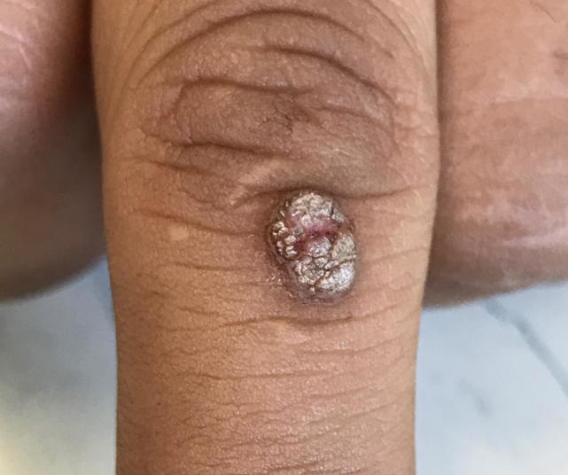 手上的瘊子如何根治,手上的瘊子怎么才能彻底治好