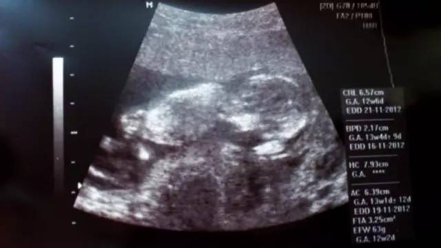 四维彩超查出胎儿不正常的指标,四维彩超看不出唐氏儿