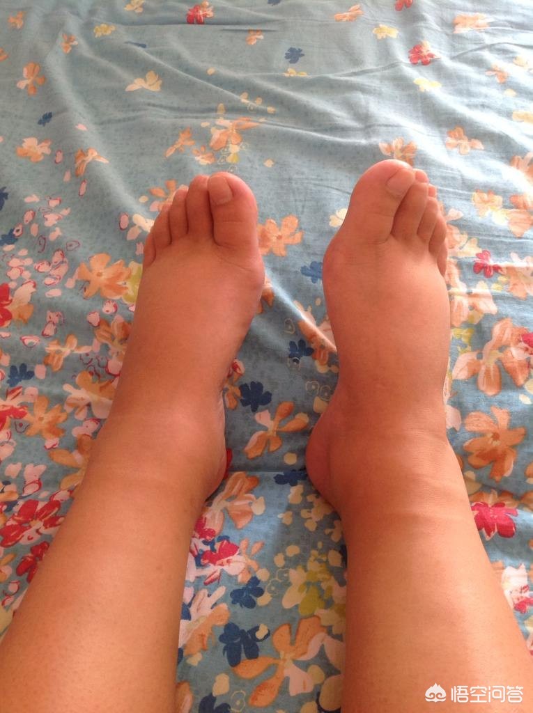 骨折术后下肢血栓好治吗,骨折术后怎样预防下肢静脉血栓