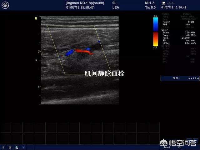 骨折手术后是麻木好还是疼好,骨折术后静脉血栓症状表现