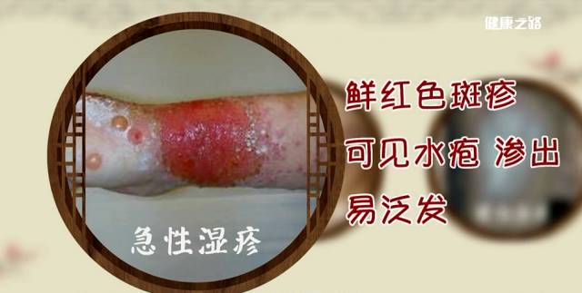 健康之路中医治痛有妙招,健康之路小经方大智慧