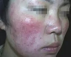 房间里有大量水银会中毒吗,水银中毒的现象