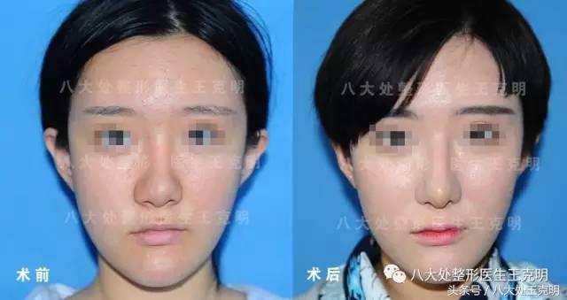 鼻整形后出现肿胀、假体外露歪斜、皮肤异样该怎么办?