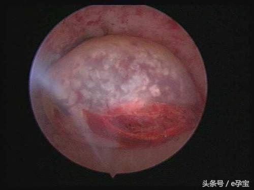 怀孕停胎流产有什么状况,怀孕停胎最初会有哪些不适