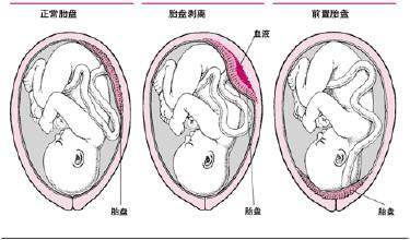 孕妇什么情况下容易发生胎盘早剥,胎盘早剥多少可致胎儿死亡