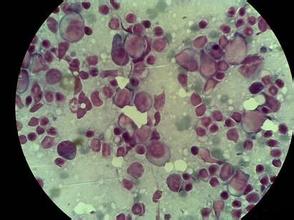 尿路上皮癌手术后化疗能活多久,尿路上皮癌术后是否需要进行治疗