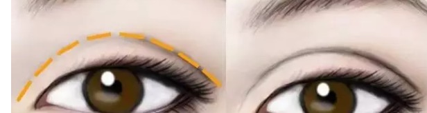 做双眼皮一个星期后感觉太宽了,第一次做双眼皮太窄了