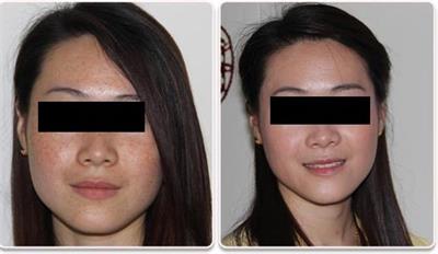 雀斑真的可以用激光彻底祛除吗,激光祛除雀斑的利弊大揭秘