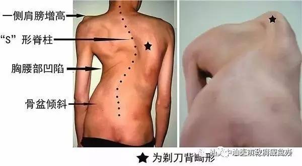 脊柱畸形可以申请补助吗,先天性结构畸形贫困能申请救助吗