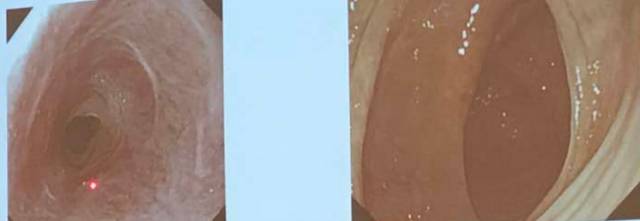 克罗恩病会引起胃部哪些症状,克罗恩消化道检查费用多少钱