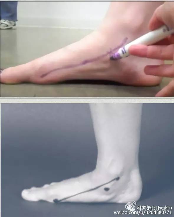 扁平足的矫正方法,2岁扁平足需要矫正么