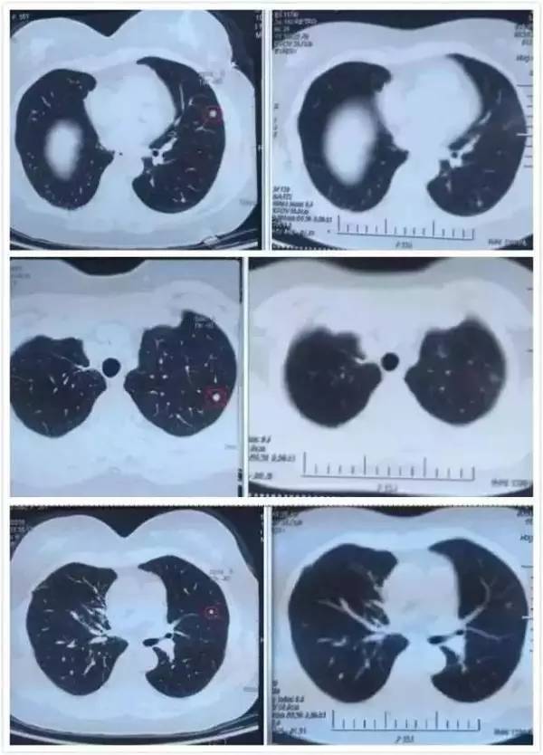 a45治疗癌症有效吗,a45治疗费用