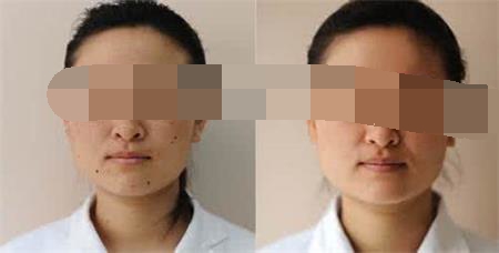 激光祛雀斑的效果好吗,翠绿宝石755nm激光祛雀斑的作用