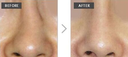 歪鼻子怎么办,歪鼻子有什么办法呢