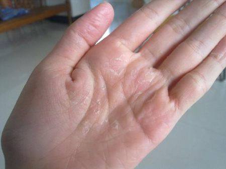 儿童热天手上有水泡是怎么回事,一到热天指尖就起小水泡怎么办