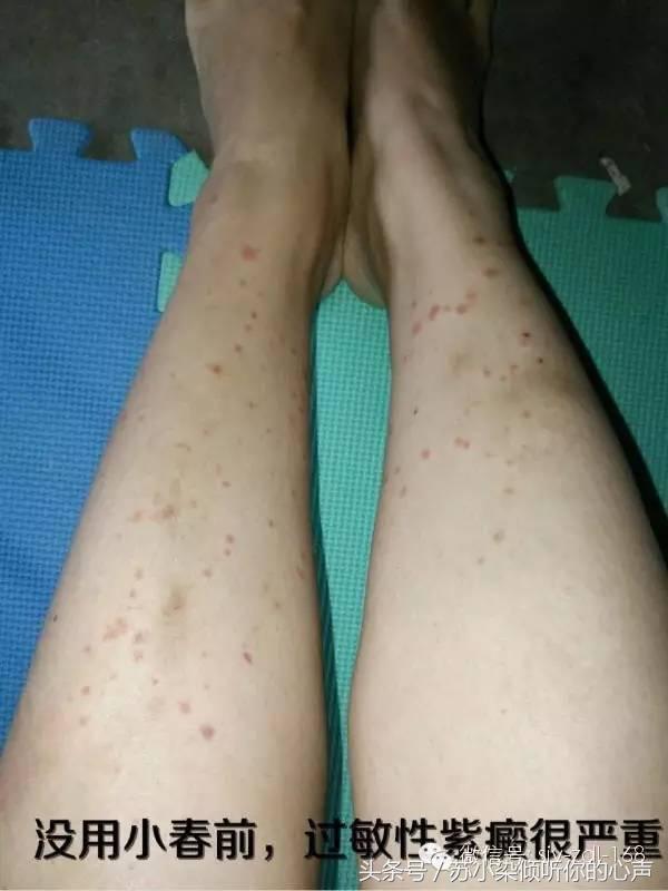 沙棘油，对皮肤还有如此神奇的效果