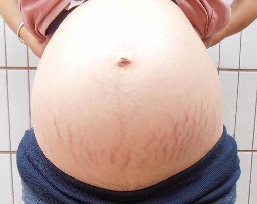 生完孩子后妊娠纹特效药,治疗妊娠纹最好的特效药