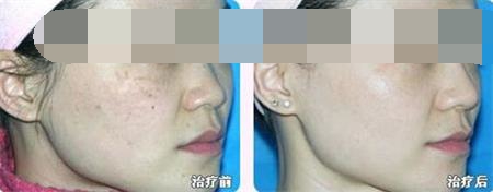 激光祛雀斑恢复后注意什么,激光去雀斑能干净吗
