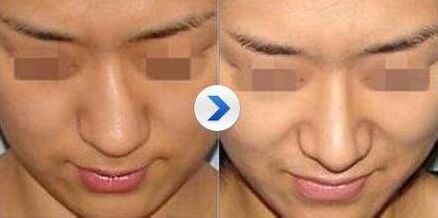 歪鼻子去哪里矫正,歪鼻子应该怎么办呢