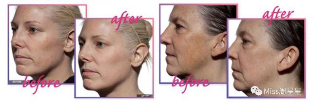 提拉紧致美容仪评测 (紧致提拉美容仪到底有没有用)