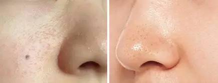 治黑头最有效方法,黑头该怎样解决